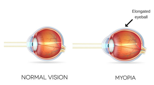 Myopia graphic